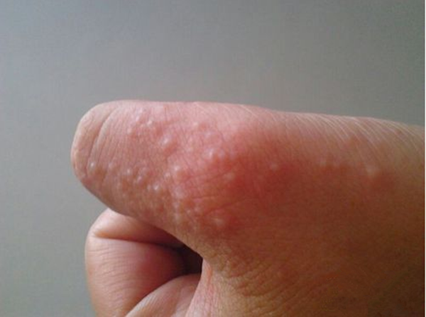 Mụn nước ở ngón tay là biểu hiện của bệnh gì? Cách điều trị hiệu quả